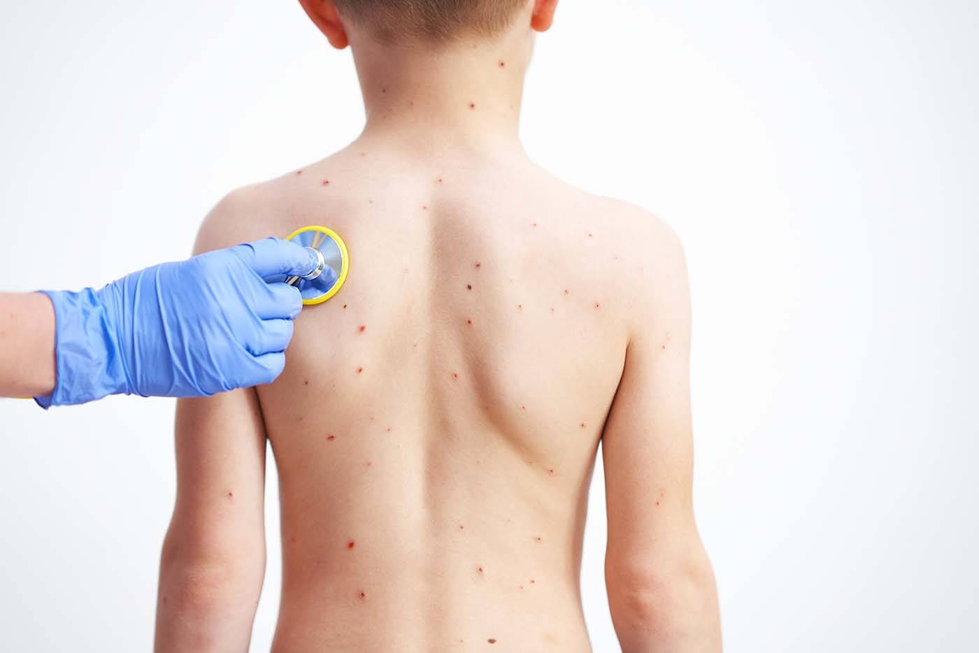 chickenpox vaccine great barr for children