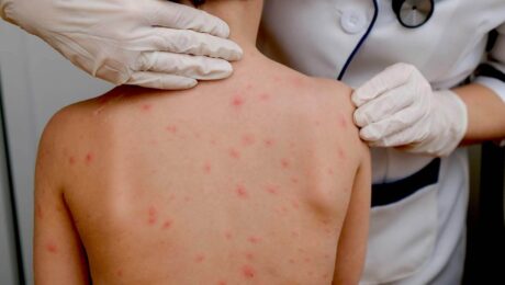 chickenpox vaccine in Great Barr