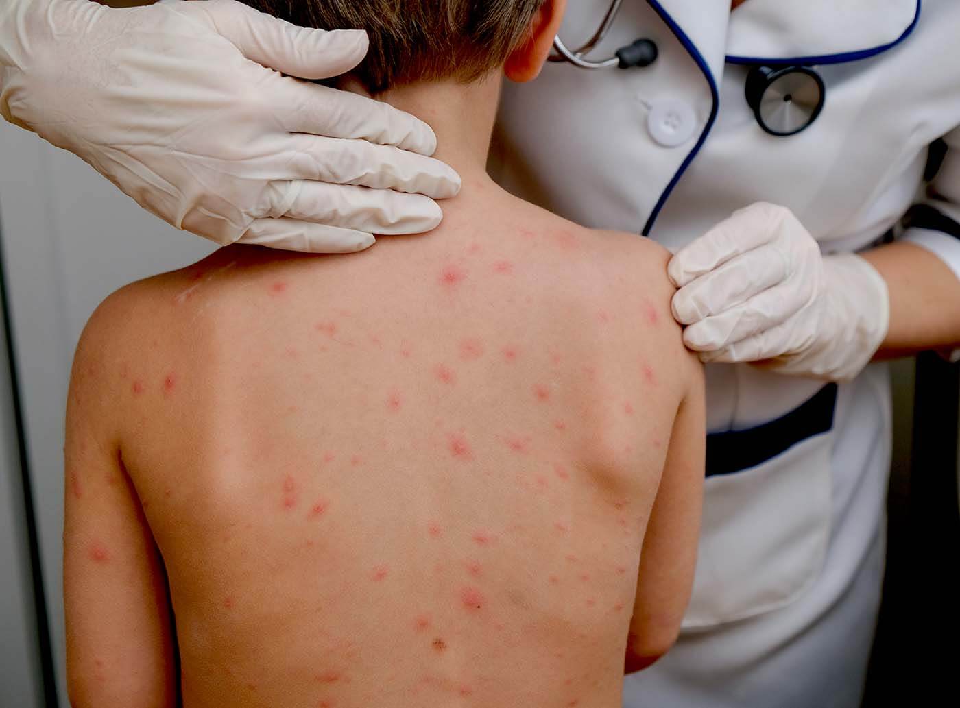 chickenpox vaccine in Great Barr