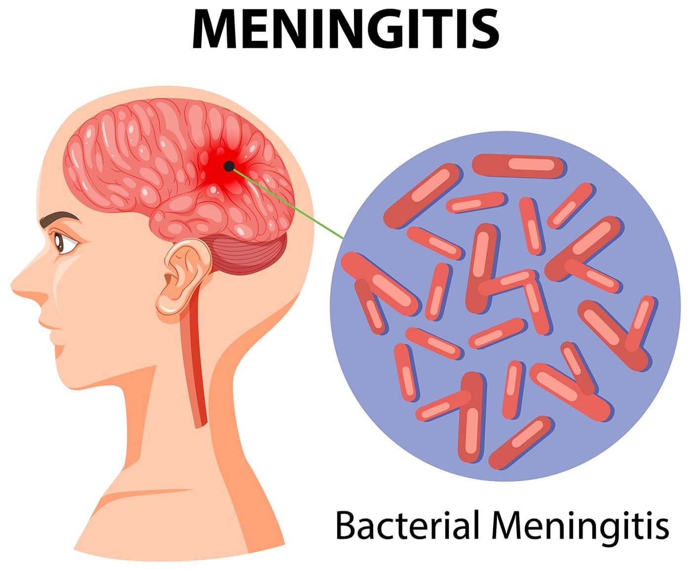 meningitis vaccination near me in great barr