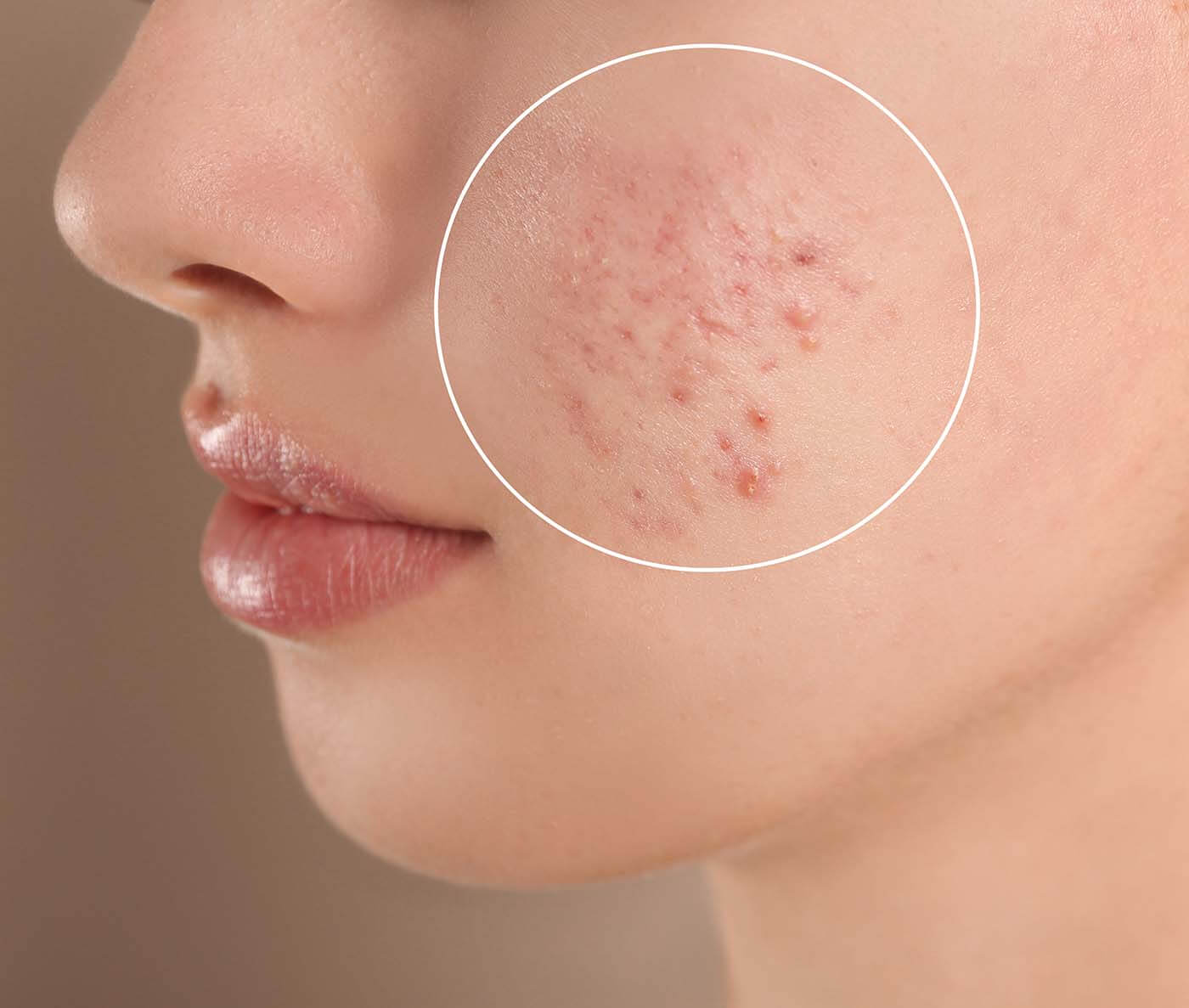 skincare acne remedy great barr