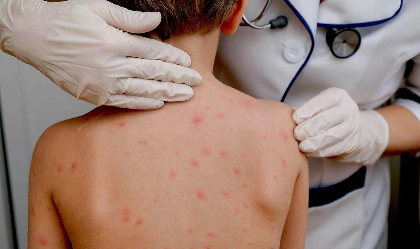 chickenpox vaccine in Great Barr