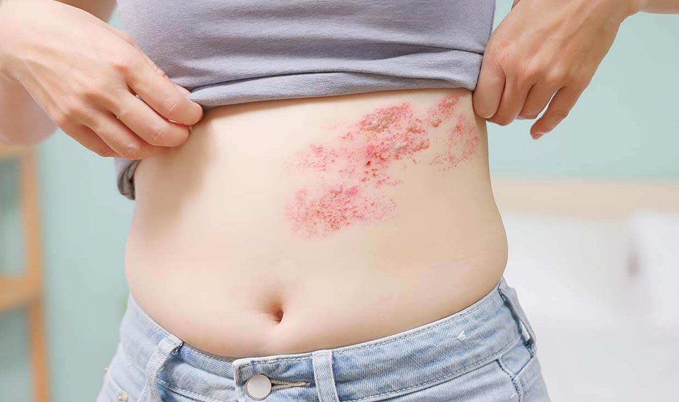 shingles vaccine service great barr