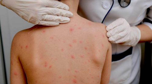 chickenpox vaccine in Great Barr