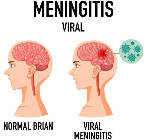 meningitis vaccine great barr