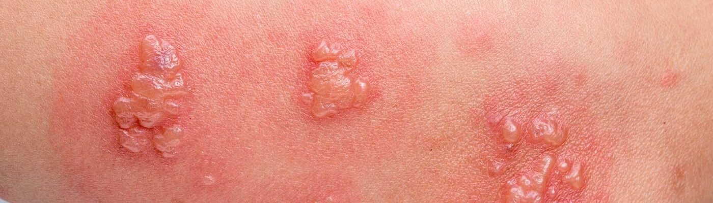 shingles vaccination great barr