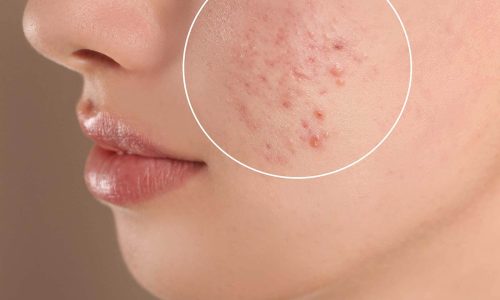 skincare acne remedy great barr